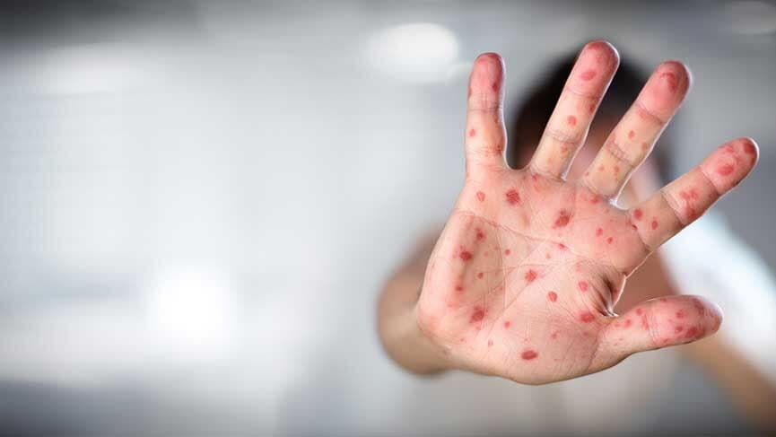 Stresin Sebep Olduğu Bir Hastalık: Zona